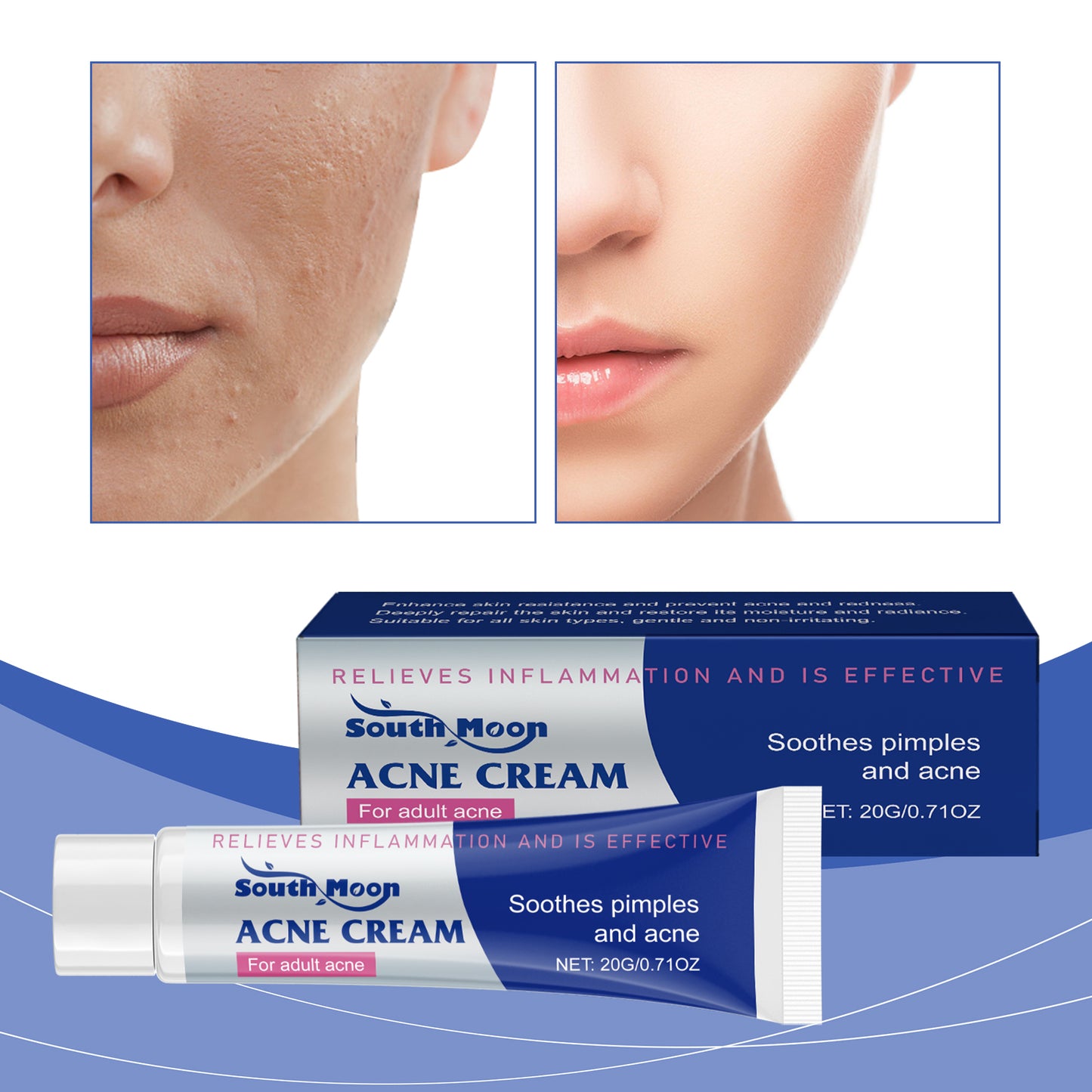 SOUTH MOON Acne Cream