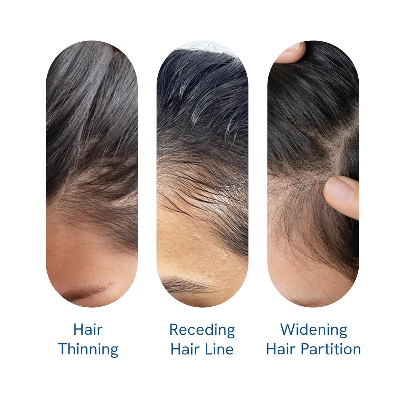 Be Bodywise Advanced Hair Growth Roll-On Serum | 3% Rosemary | 2% Aminexil | 3% Redensy l 2% Anagain | Precision Scalp Applicator | Paraben & Sulphate Free | Non oily and mess free-WWJ