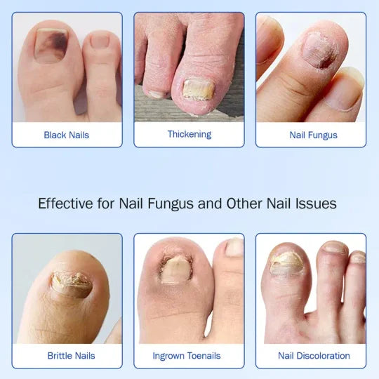 Fungal Nail Patches, 21pcs/box Nail Health Care Patches, Nail Fungus Care Patches, Suitable for Solving Fungal Nails and Other Nail Problems, Nail Supplies, Daily Care Nails Kit Set-hz