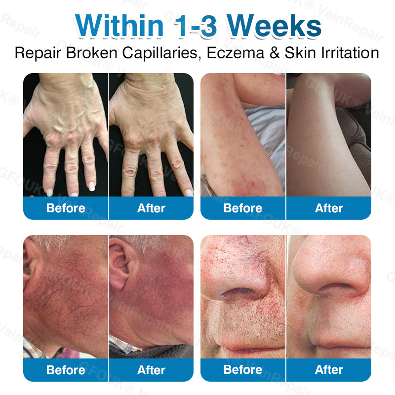 🇺🇸🏆✅️🏃Pryxo™ VeinRepair Microneedle Patch Roll⚡Instant Relief, Long-Term Results