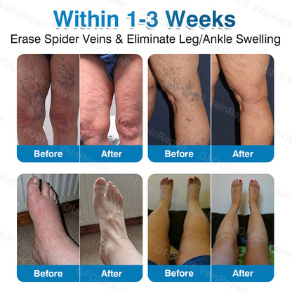 🇺🇸🏆✅️🏃Pryxo™ VeinRepair Microneedle Patch Roll⚡Instant Relief, Long-Term Results