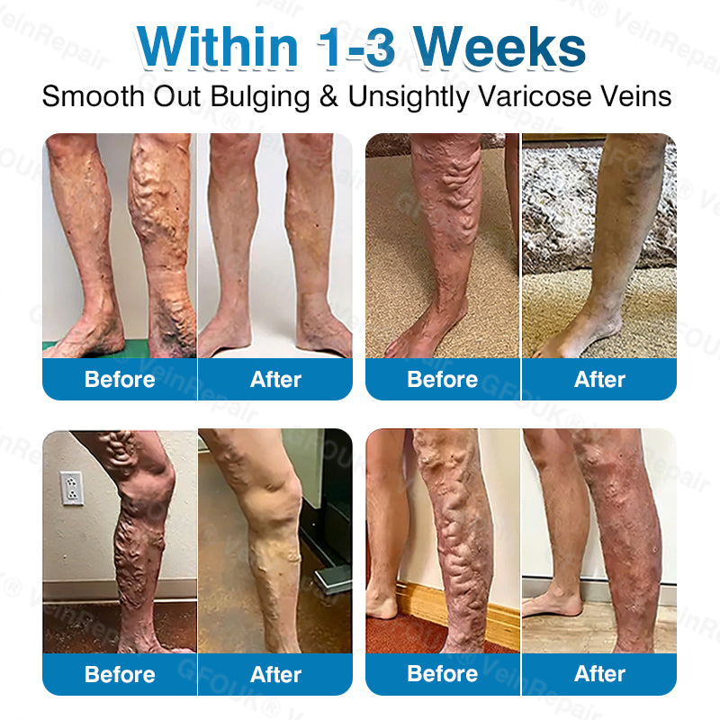 🇺🇸🏆✅️🏃Pryxo™ VeinRepair Microneedle Patch Roll⚡Instant Relief, Long-Term Results