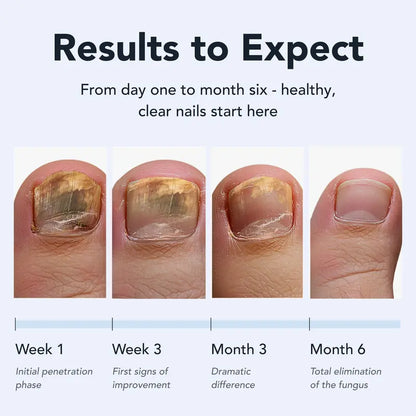 Toenail Fungus Pen - UNDECYLENIC ACID 25% - Daily Solution for Brittle & Thickened Nails