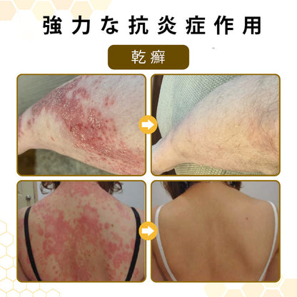 🫧CleraNaure® プソリアスーズ ミツバチ毒配合スキンリストアクリーム