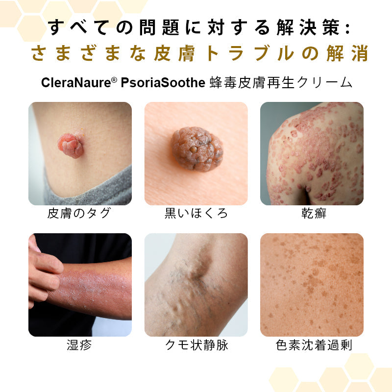 🫧CleraNaure® プソリアスーズ ミツバチ毒配合スキンリストアクリーム