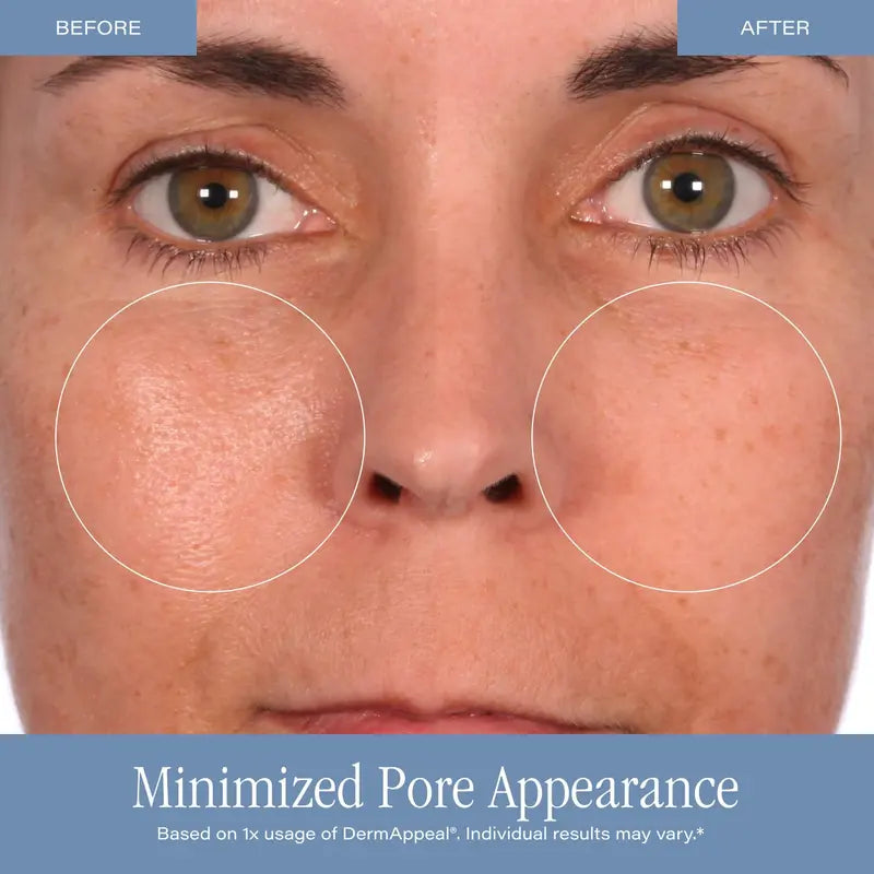 DermAppeal Microdermabrasion BeautyTreatment w/ V5 Crystal Technology Facial Exfoliate Tube - Powerful Microdermabrasion Skincare Treatment for All Skin Types Brightening Exfoliating Moisturizing Chemical Exfoliant
